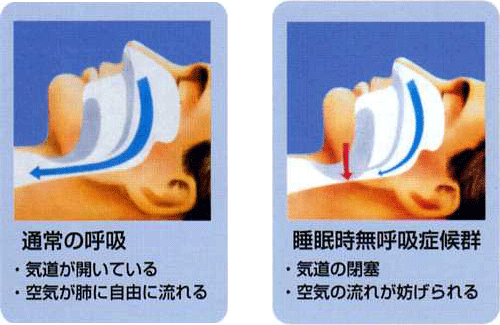 通常の呼吸と睡眠時無呼吸症候群