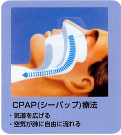 ＣＰＡＰ（シーパップ）